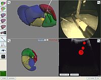 Planning tool for high precision navigation in the liver