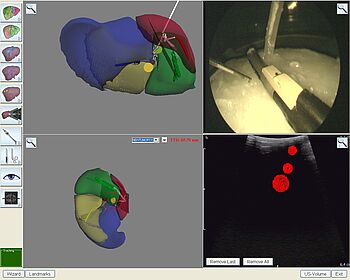 Planungstool zur präzisen Navigation in der Leber